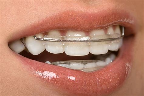 does maxicare cover dental braces|Frequently Asked Questions .